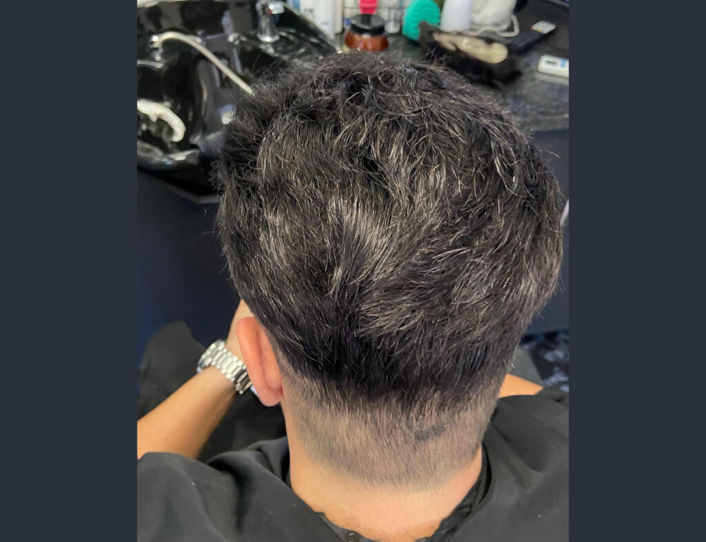 Non-Surgical Hair Replacement in Johannesburg