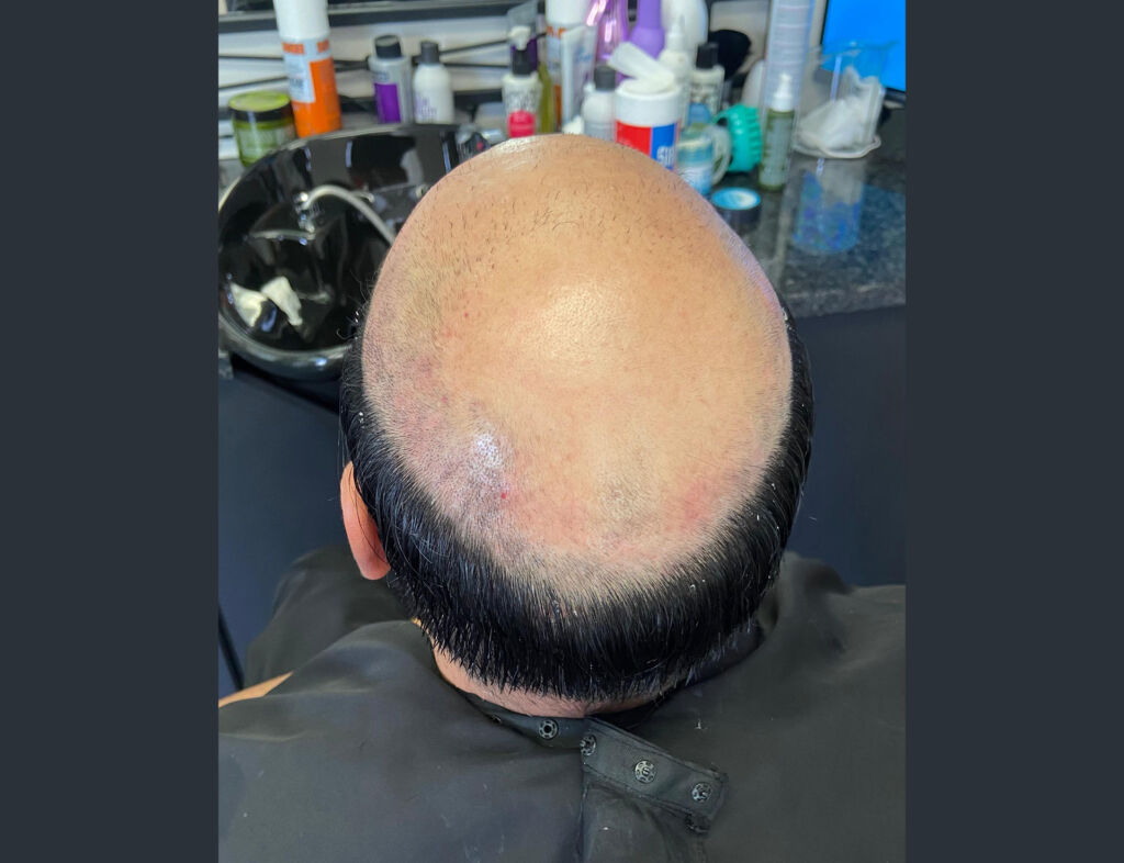 Non-Surgical Hair Replacement in Johannesburg