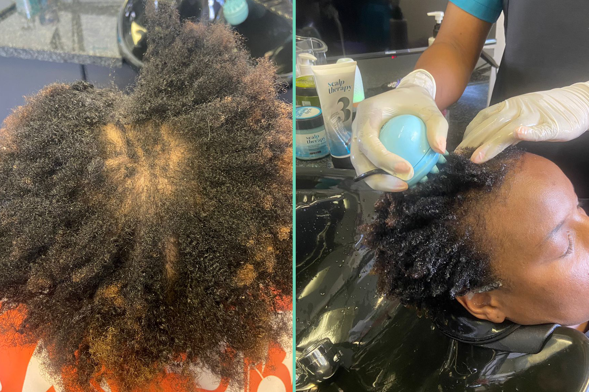 Scalp Treatment in Johannesburg North